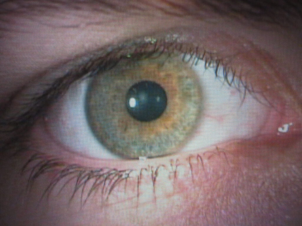 Kann eine Kontaktlinse im Auge verschwinden? MuenchOptik Köln Longerich